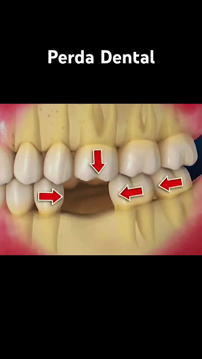 Perda Dental #shorts