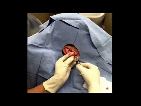 Earlobe Repair: Full Excision And Repair To Right Side. For Medical Education- NSFE.