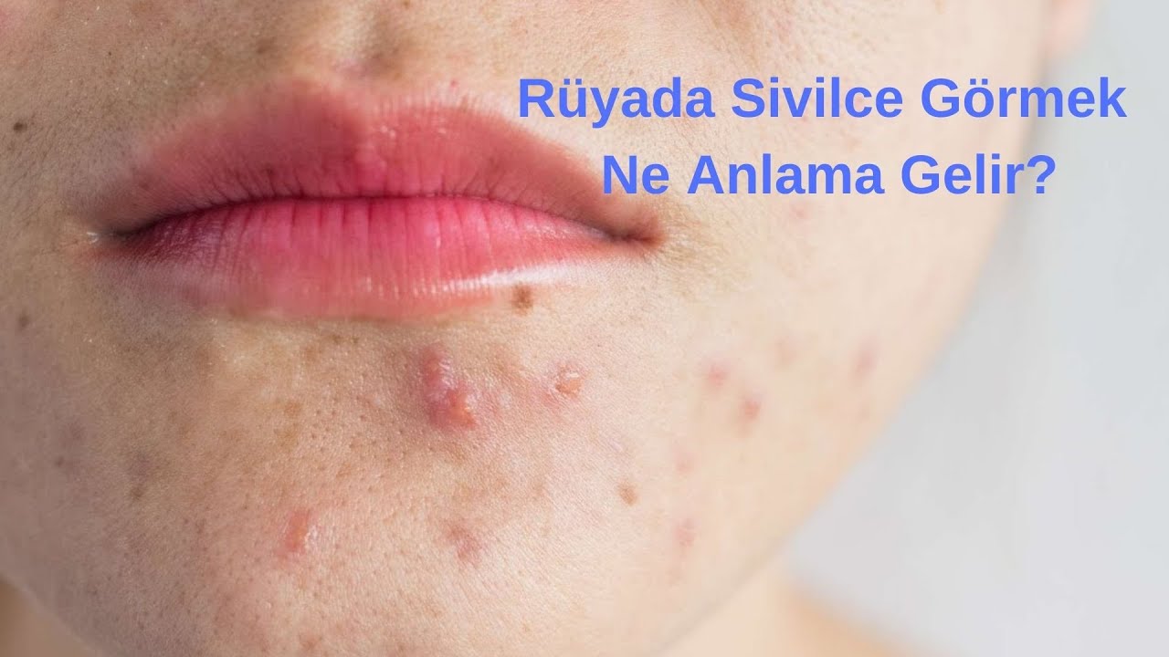 Ruyada Sivilce Gormek Ne Anlama Gelir Youtube