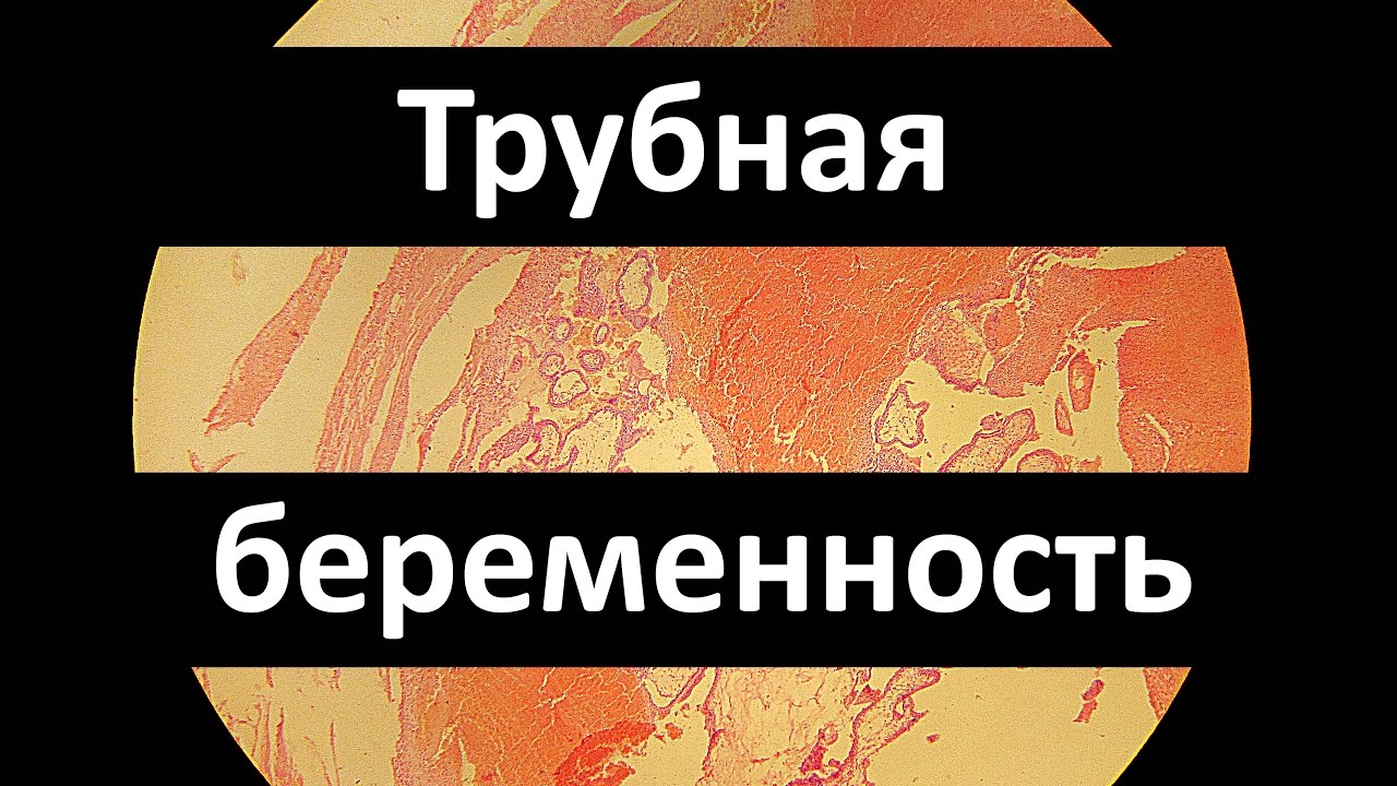 Трубная беременность | Патанатомия - YouTube