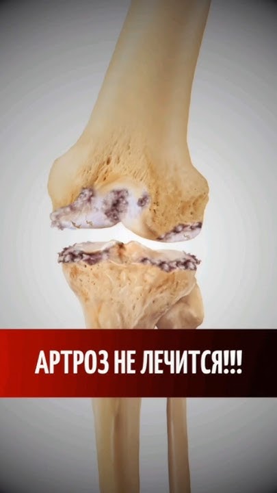 Артроз не лечится!!! #артроз #гонартроз #коксартроз #лфк #больвспине # ...