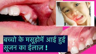 Swelling of gums in milk teeth! Pus discharge in kids teeth!