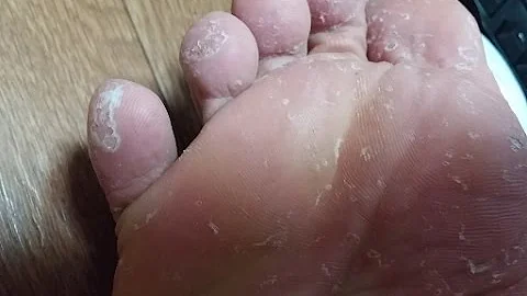 ハイヒールかかと水虫 Mp3 ハイヒールかかと水虫 Mp3