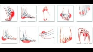 bol u stopalima i zglobu prilikom hodanja