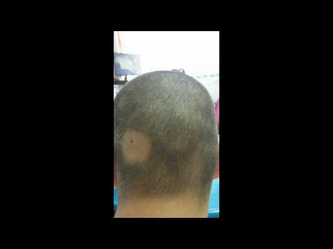 Alopecija areata prirodno liječenje