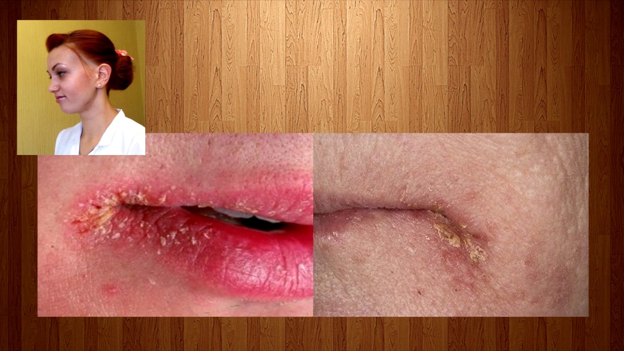 Заеды .Причины ,фото,лечение - YouTube