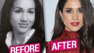 Amazing 😍. Meghan Markle's transformation and plastic surgery analysis.