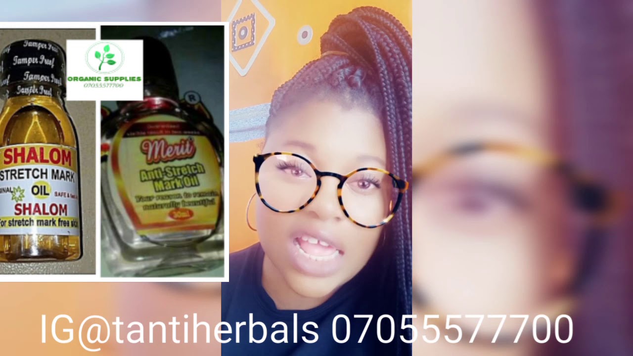 shalom stretch mark removal