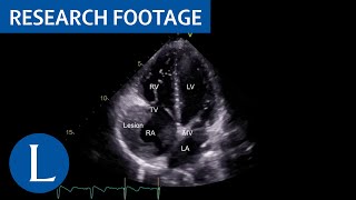 Severe disseminated tuberculosis in HIV-negative refugees: video 1 of 2