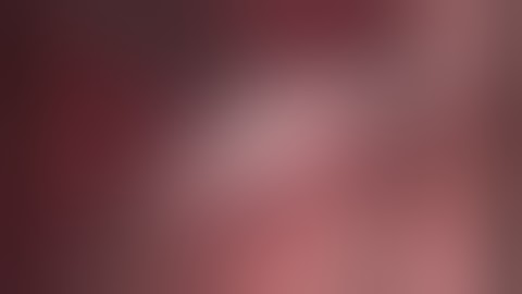 Wedge Resection of Solitary Pulmonary Nodules Through Uniportal VATS 5