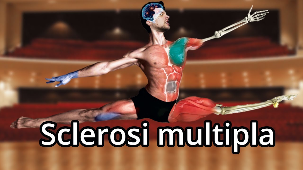 Perché la SCLEROSI MULTIPLA è roba seria? - Spiegazione