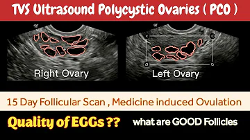 Polycystic Ovarian Disease ( PCOS  ) || TVS Ultrasound Follicular Scan | Egg Quality for Ovulation