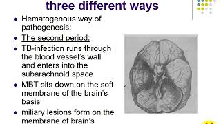 Miliary tuberculosis  Tuberculous meningitis screenshot 1
