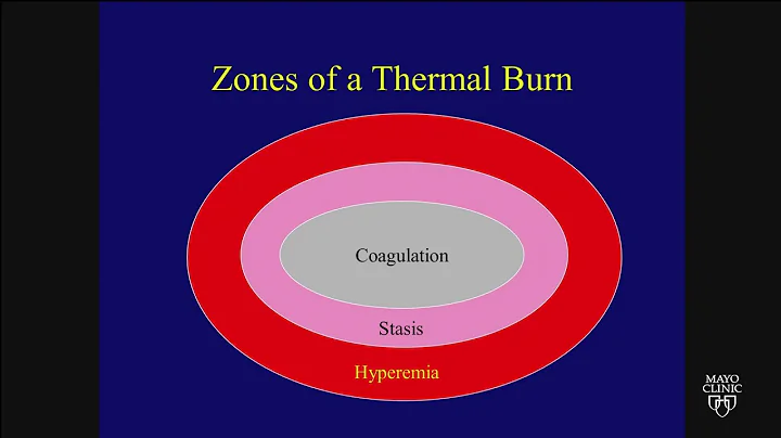 Burn Management for the Non-Burn Surgeon by Henry ...