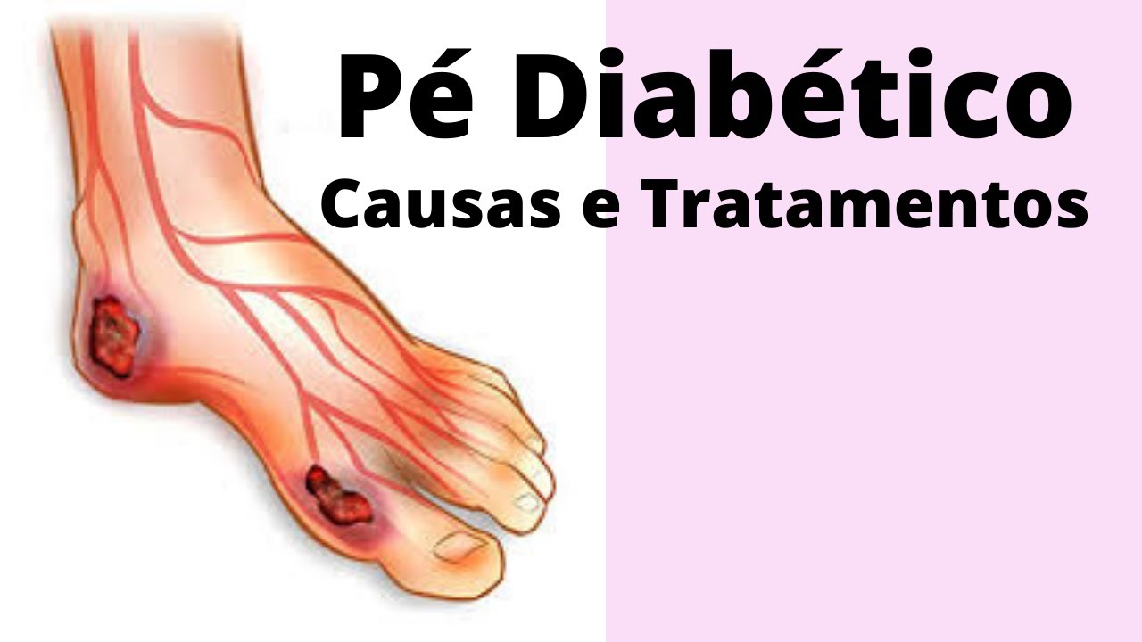 Pé Diabético Causas e Tratamentos YouTube
