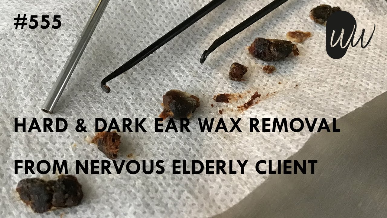 555 Hard & Dark Ear Wax Removal from Nervous Elderly Client YouTube