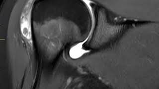 Bursitis of shoulder | First Look MRI