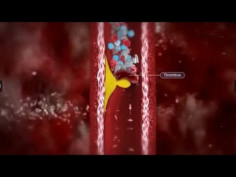 Video: Was ist Arteriosklerose Arteriosklerose und Arteriolosklerose?