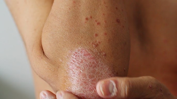 What Is Plaque Psoriasis