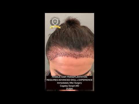 Female pattern hair loss clinical grading scale Stage 1 is considered   Download Scientific Diagram