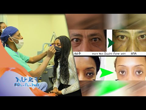 ቪዲዮ: Blepharoplasty ማግኘት አለብኝ?