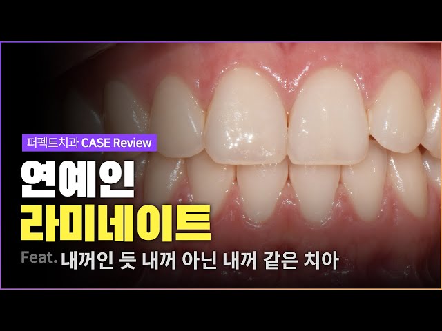 0.2mm 최소삭제로 티 안나고 자연스럽게!  | 연예인 라미네이트🤭