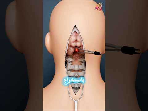 كيف يعالج الأطباء تجلط الدم في الدماغ