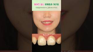 벌어진 앞니 치료 벌어진 치아 개선법은? #안양올리브치과 #비산동미니쉬 #shorts