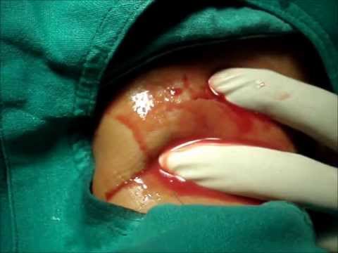 female abscess drainage surgical