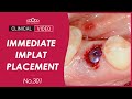 45 immediate implant placement posterior single scrp modelless dr cho yongseok dr kim sewoung