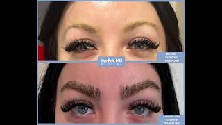 Before & After FUT Eyebrow Transplant | Jae Pak MD Medical