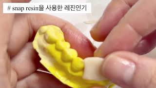 상악 4전치 임플란트 임시치아 레진인기 (snap)