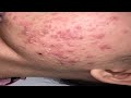 Acne Treament Under The Skin #046