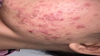 Acne Treament Under The Skin #046