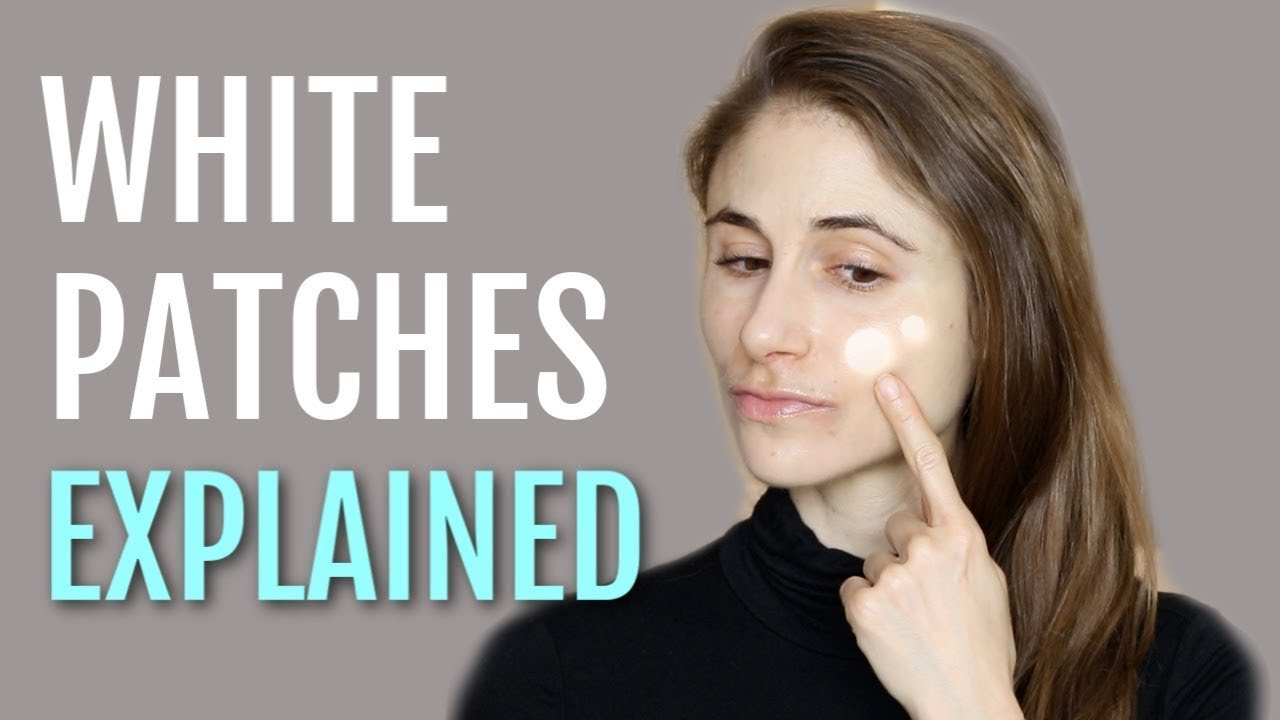 What causes white spots on face? YouTube