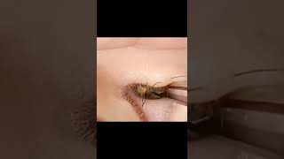 Remove ear wax infection #03