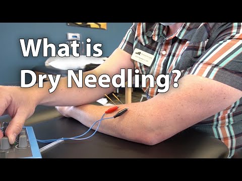 What is Dry Needling?