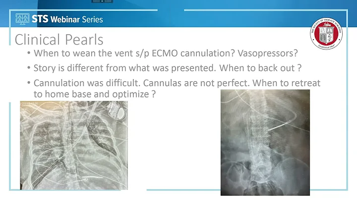 Dos and Don'ts of the Mobile ECMO Team (March 3, 2...