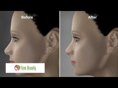 Video Mô phỏng quá trình phẫu thuật độn cằm - youtube