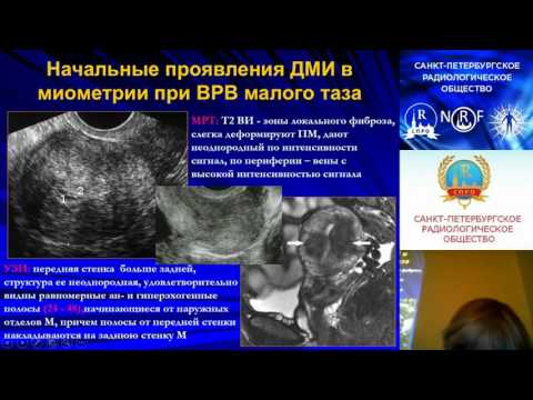 Л.Е.Шарова Дифференциальная диагностика варикозной болезни вен малого таза