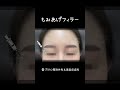 体験団┃もみあげフィラー┃凹んだもみあげでひょうたんのような顔型の変身⚱┃ブラウン美容皮膚科┃ #渡韓 #美容 #韓国 #ヒアルロン酸 #フェイスライン #垢抜け #レポート