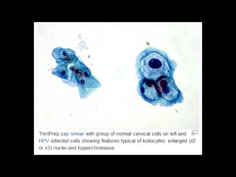 Lab or Diagnostic Findings: Koilocytes (HPV: predisposes to cervical cancer)