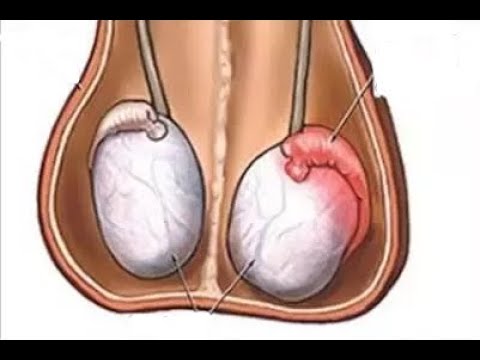 الأسباب المؤدية إلى آلام الخصية أسبابها وعلاجها يوتيوب