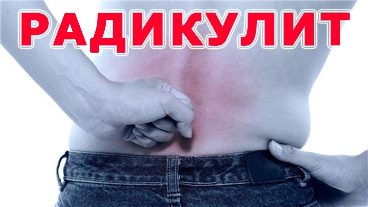 Исцеление радикулита народными способами Исцеление радикулита народными способами