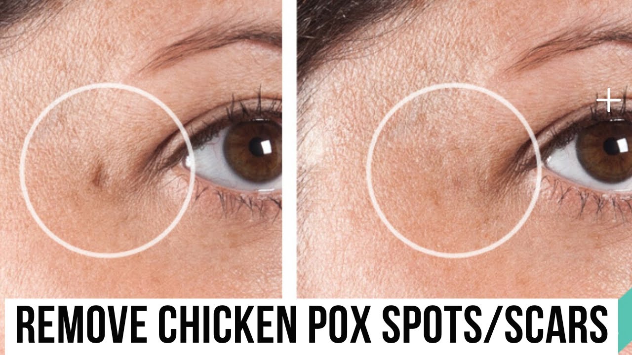 HOW TO REMOVE CHICKEN POX SPOTS/SCARS NATURALLY  works 