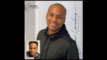 Scalp micro pigmentation results out of this world by Daniel Yerenburg