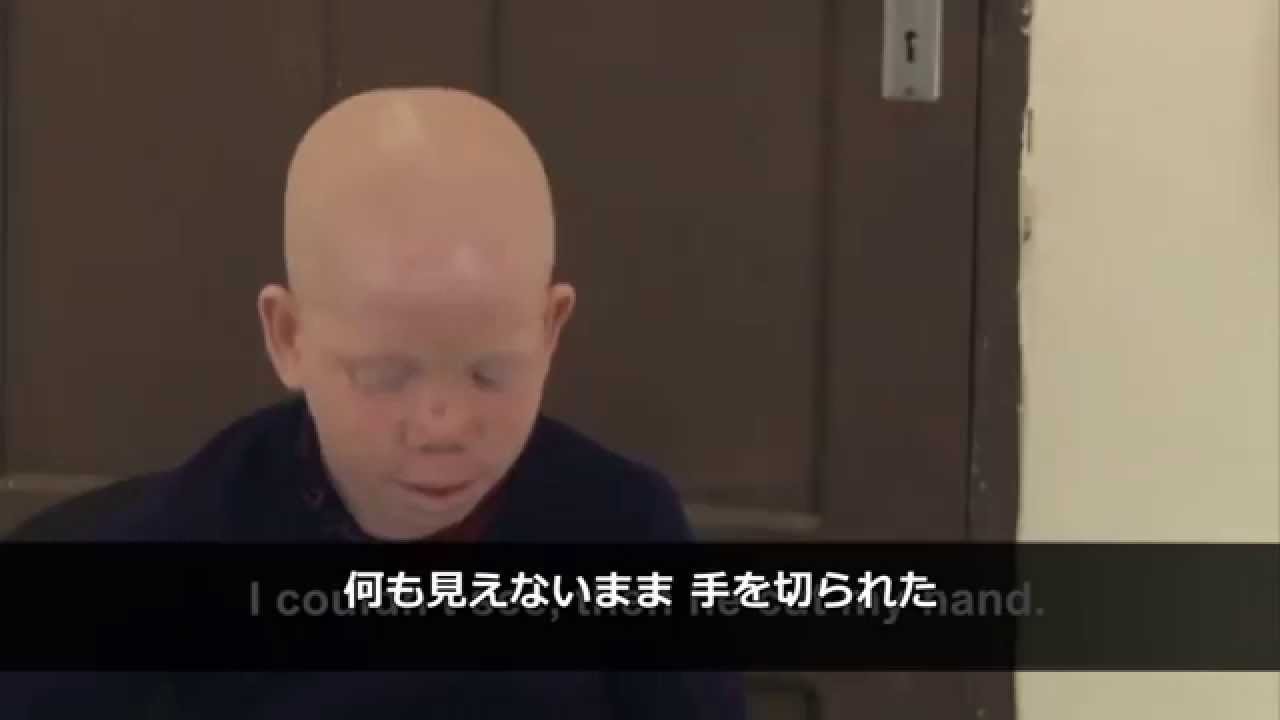 タンザニア 暴力にさらされる白皮症 アルビニズム の人々 Youtube タンザニア 暴力にさらされる白皮症 アルビニズム の人々 Youtube