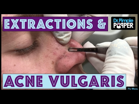 Working Hard for these Blackheads:  Acne Vulgaris & Extractions Session 