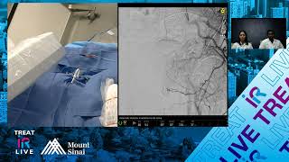 Transradial Prostate Artery Embolization using n-BCA Glue for Benign Prostatic Hyperplasia (BPH)