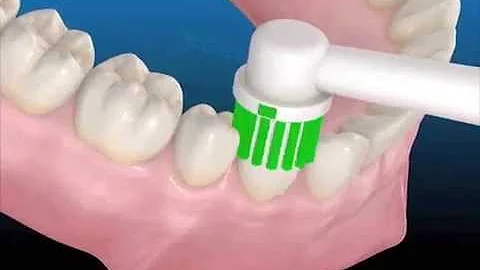 ¿Cómo se cepilla con periodontitis?